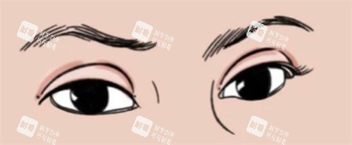 雙眼皮肉條感 雙眼皮肉條感