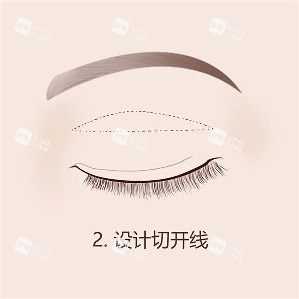 雙眼皮手術(shù) 雙眼皮手術(shù)