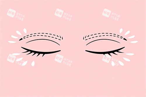 雙眼皮整形卡通圖 雙眼皮整形卡通圖