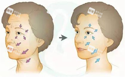 面部除皺對比圖