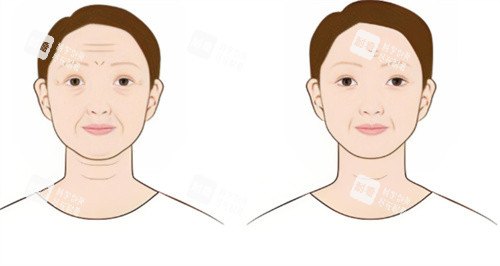 面部除皺術(shù)