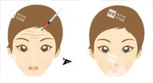 打針除皺前后對比圖