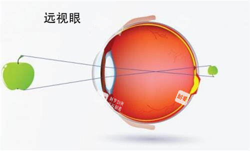 遠(yuǎn)視眼睛的視力