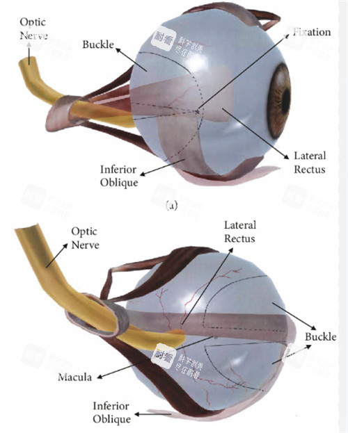 后鞏膜加固術(shù)動畫演示 后鞏膜加固術(shù)動畫演示