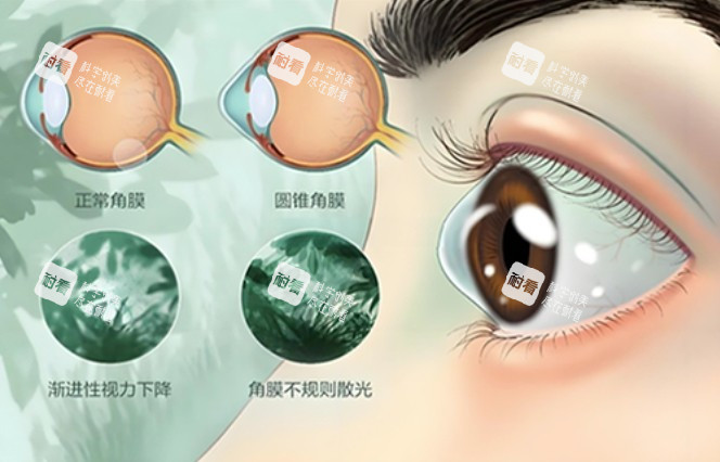 鞏膜鏡改善問題 鞏膜鏡改善問題