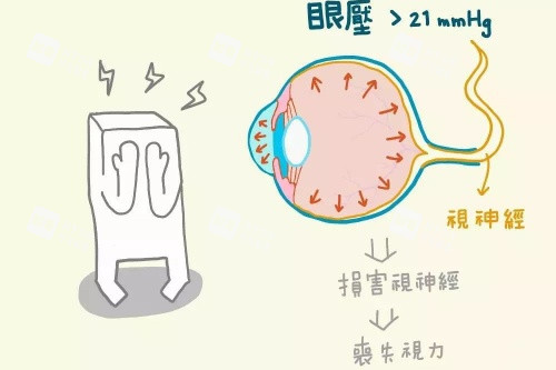 青光眼概念圖片解釋