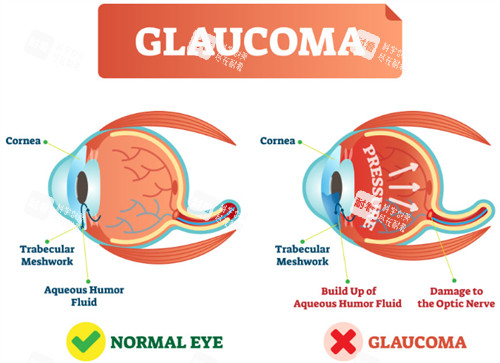 正常眼睛和青光眼的對(duì)比