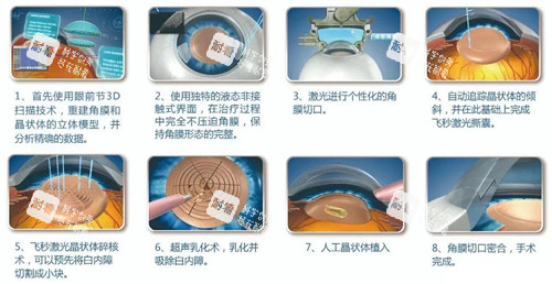 超聲乳化白內(nèi)障手術(shù)細(xì)節(jié) 超聲乳化白內(nèi)障手術(shù)細(xì)節(jié)