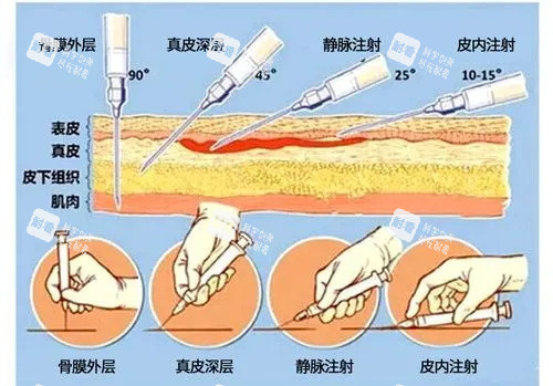 愛(ài)貝芙注射示意圖 愛(ài)貝芙注射示意圖