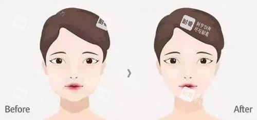面部輪廓整形前后對比圖