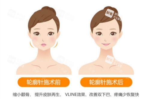 輪廓針卡通對比圖