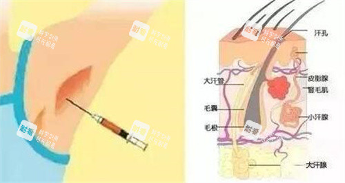 不手術去腋臭卡通圖改善