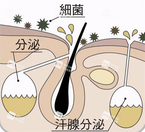 腋臭是怎么形成的