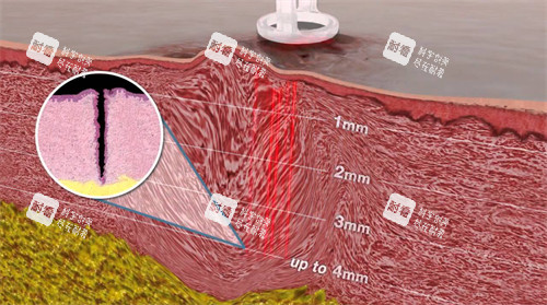 皮膚內(nèi)的疤痕紋理 皮膚內(nèi)的疤痕紋理