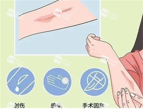 疤痕增生因素圖 疤痕增生因素圖