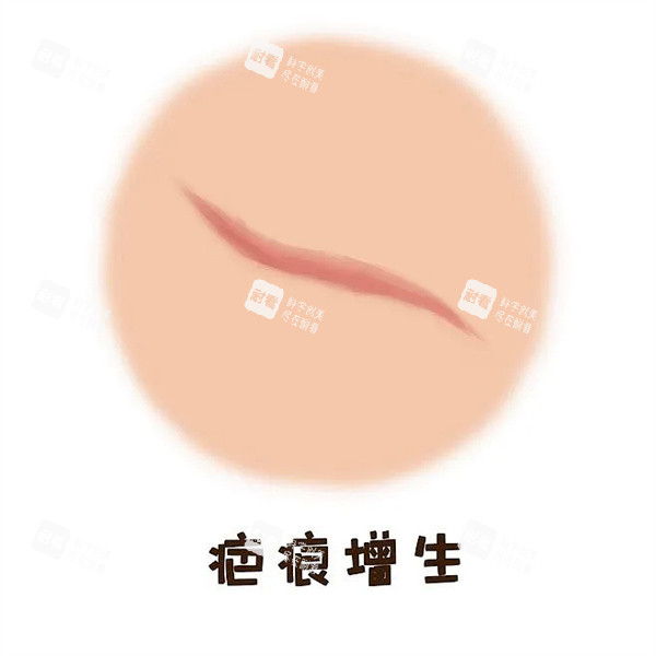 疤痕增生圖片 疤痕增生圖片