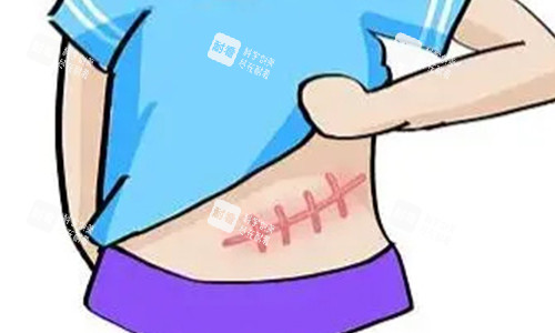 腹部疤痕增生的動畫圖 腹部疤痕增生的動畫圖