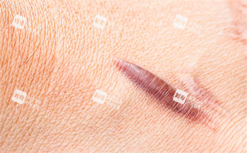 疤痕疙瘩2 疤痕疙瘩2