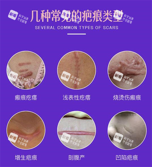 常見的疤痕類型照片 常見的疤痕類型照片