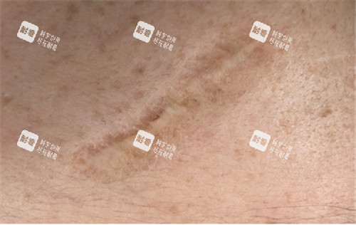 疤痕治療圖 疤痕治療圖