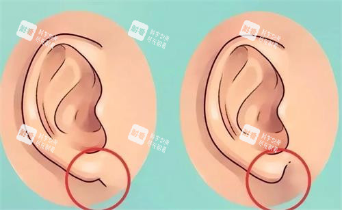 耳垂整形 耳垂整形