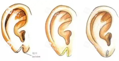 耳垂裂開修復(fù)的過(guò)程 耳垂裂開修復(fù)的過(guò)程