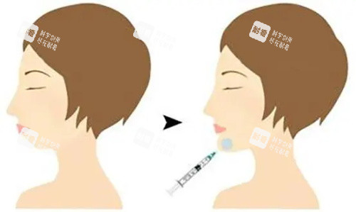 注射墊下巴前后的區(qū)別 注射墊下巴前后的區(qū)別