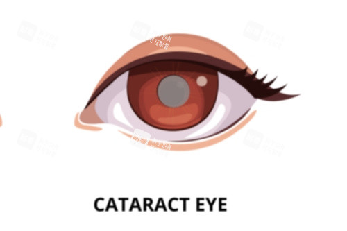 白內(nèi)障眼睛