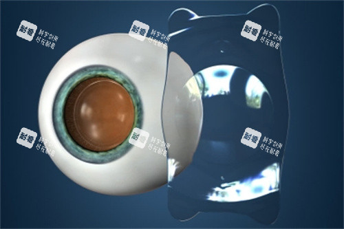 眼睛植入ICL晶體