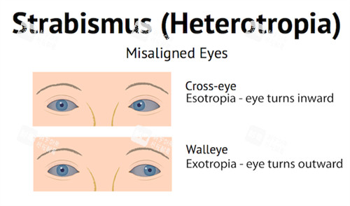正常眼睛和斜視眼睛對比