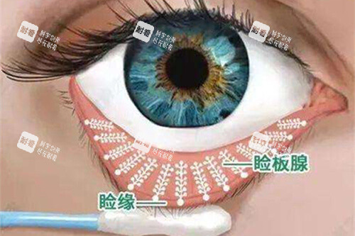 眼睛瞼緣和瞼板腺漫畫圖
