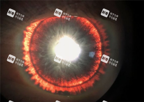 虹膜缺損的眼睛 虹膜缺損的眼睛