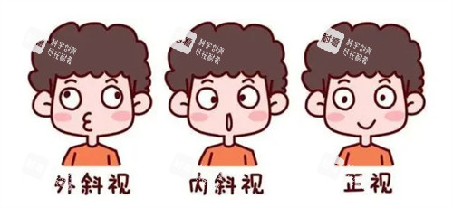 外斜內(nèi)斜和正常眼睛的對(duì)比圖 外斜內(nèi)斜和正常眼睛的對(duì)比圖