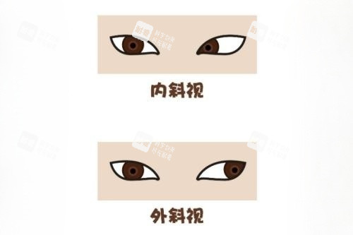 眼睛內(nèi)斜視和外斜視卡通對(duì)比圖 眼睛內(nèi)斜視和外斜視卡通對(duì)比圖