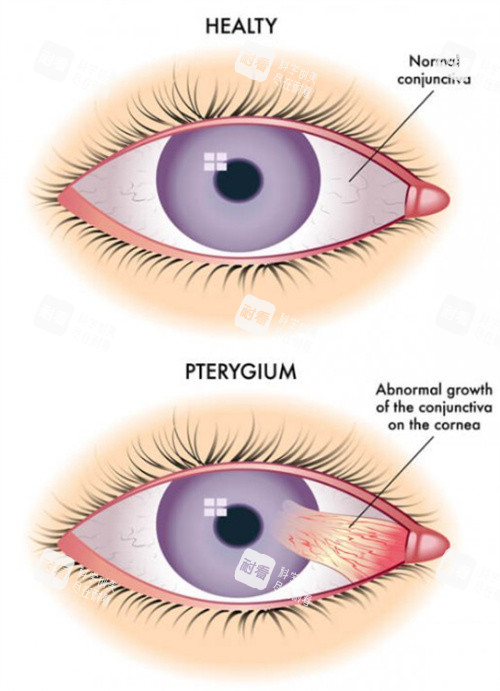 正常眼睛的翼狀胬肉 正常眼睛的翼狀胬肉