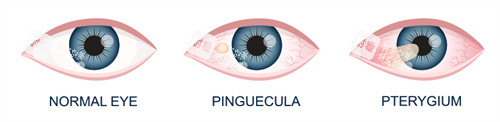 翼狀胬肉的眼睛 翼狀胬肉的眼睛