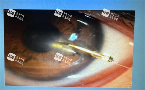 眼睛白斑治療 眼睛白斑治療