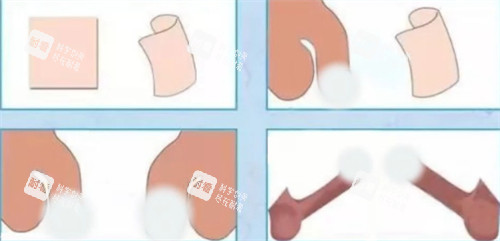 陰莖生物補(bǔ)片手術(shù)前后對比