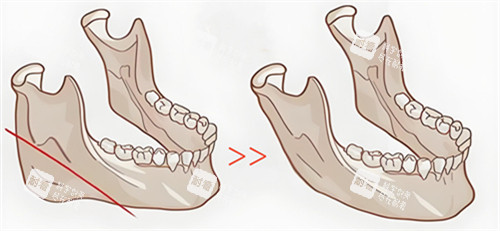 下頜骨切除步驟動畫演示圖