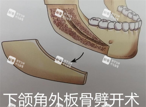 下頜角外板劈開術(shù)