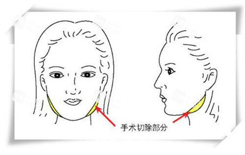 下頜角截骨手術(shù)