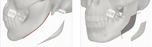 下頜角手術(shù)