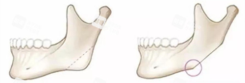 下頜骨切除前后動畫演示圖