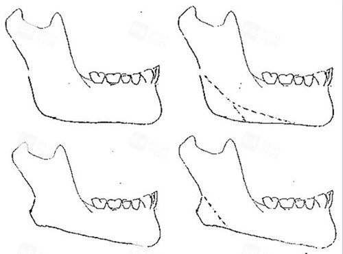 下頜角整形多次截骨示意圖