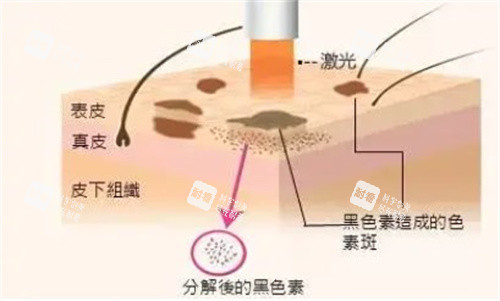 激光祛斑手術(shù)原理圖 激光祛斑手術(shù)原理圖