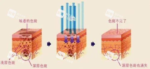 激光祛斑治療示意圖 激光祛斑治療示意圖