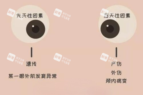 眼睛斜視產(chǎn)生原因卡通圖片 眼睛斜視產(chǎn)生原因卡通圖片