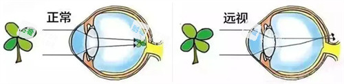 正常眼睛成像和遠(yuǎn)視眼睛成像 正常眼睛成像和遠(yuǎn)視眼睛成像