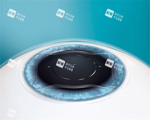 人工晶體植入眼睛后圖示 人工晶體植入眼睛后圖示