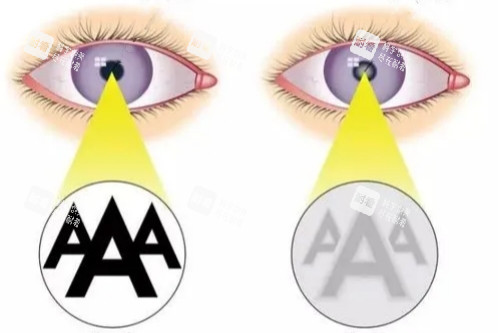 白內(nèi)障與正常眼睛視物卡通圖 白內(nèi)障與正常眼睛視物卡通圖